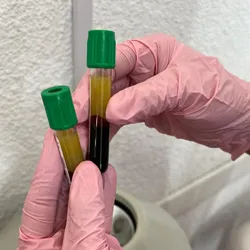 Plasma rico en plaquetas  + exosomas o vitaminas 
