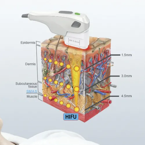 HIFU Facial