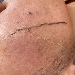 Higiene Facial profunda con Dermaplaning