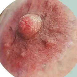 Micropigmentacion Paramedica: Reconstruccion y definicion de Areolas
