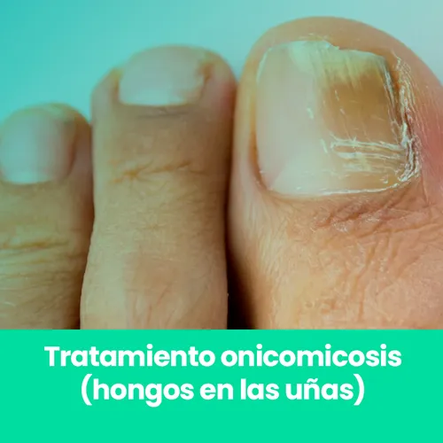 Tratamiento onicomicosis (hongos en las uñas)