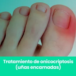 Tratamiento de onicocriptosis (uñas encarnadas)