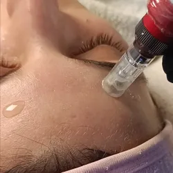 Microneedling Facial (dermapen)