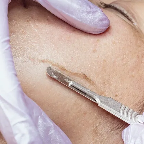 Dermaplaning