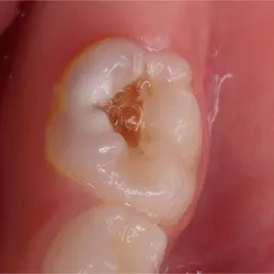 ARREGLO DE CARIES