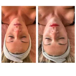 Limpieza facial premium (incluye dermapen ,bb lips y Madero)
