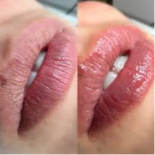 Promo Dermapen Facial+ Hidralips