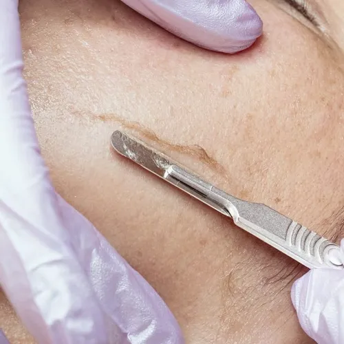 Dermaplaning Peel