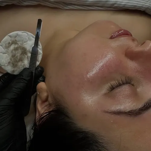 Dermaplaning
