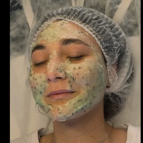 Peeling