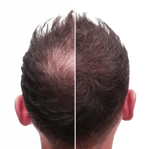 Finasteride + Dutasteride (Capilar) 