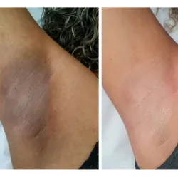 Tratamiento para manchas con luz pulsada ipl 