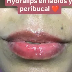 Hydralips