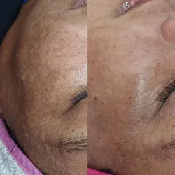 Tratamiento Despigmentante (facial )🌷