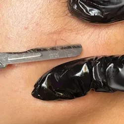 Dermaplaning 