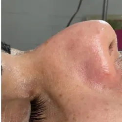 LIMPIEZA FACIAL C/ EXTRACCIONES