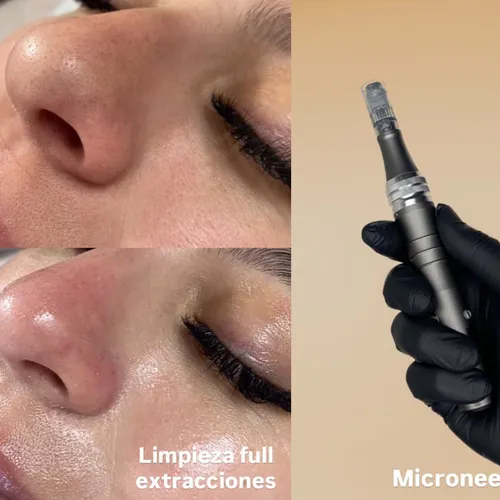 LIMPIEZA FACIAL C/ EXTRACCIONES + DERMAPEN