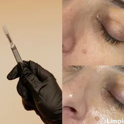 LIMPIEZA FACIAL C/ EXTRACCIONES+DERMAPLANING