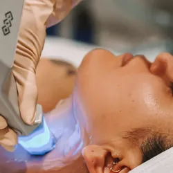 Exilis facial 