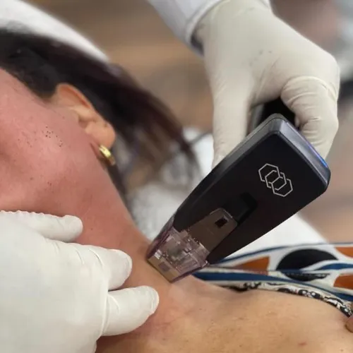 Thermage facial