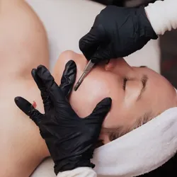 Dermaplaning Renovación Cutánea 