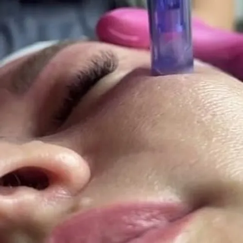Dermapen 