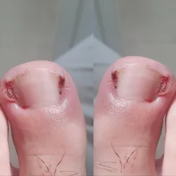 Atención podológica uñas encarnadas ( bilateral)