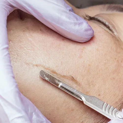 Dermaplanning