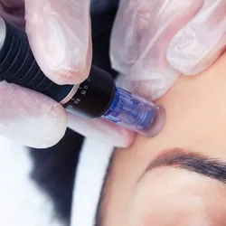 Dermapen (microneedling)