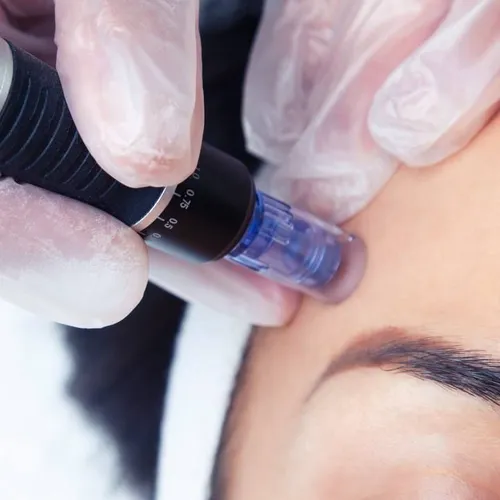 Dermapen (microneedling)