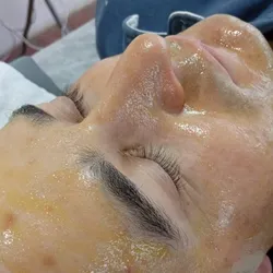 Peeling Quimico(según necesidad)