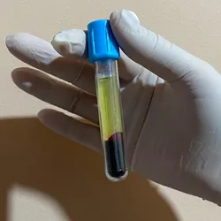 PLASMA RICO EN PLAQUETAS