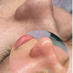 Limpieza facial completa con extracción de puntos negros 