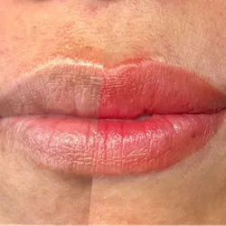 Neutralización de Labios Oscuros