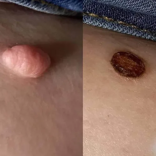 extracción de verrugas 