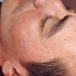 ✨ Reparación Dermal Pro(Corrección de Secuelas de Acné)✨