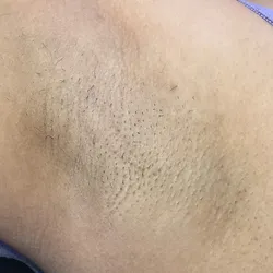 Blanqueamiento de axilas 