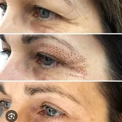 Trat .Fibroblast rejuvenecedor , lifting facial sin cirugías 