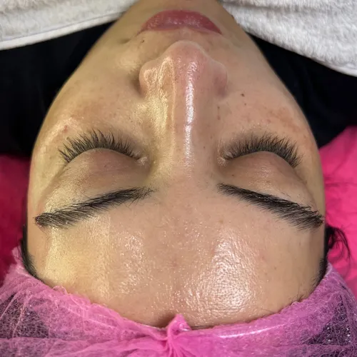 Dermaplaning 