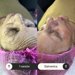 Tratamiento Antiage