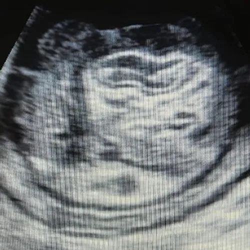 Ecografia Abdominal 