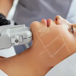Tensado profundo con HIFU 22D: Rostro, papada, cuello y escote (PROMO) 