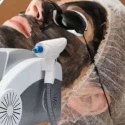 HOLLYWOOD PEEL (Lifting,tatuajes,manchas,lines de expresion)