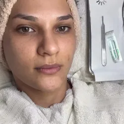 Dermaplaning: glow 