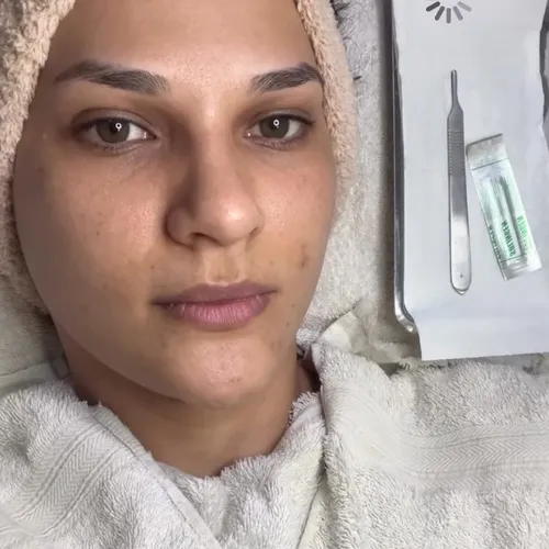 Dermaplaning: glow 