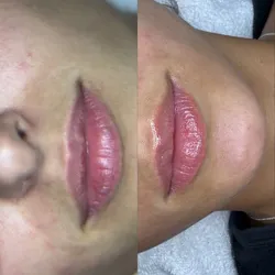 Hydra Lips