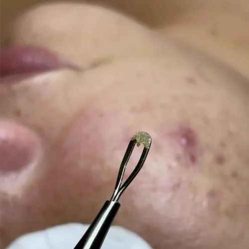 Acne Sec