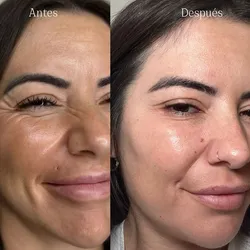 Exosomas facial