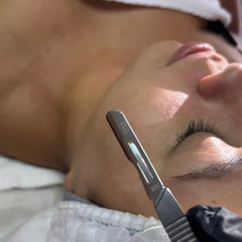 Dermaplaning