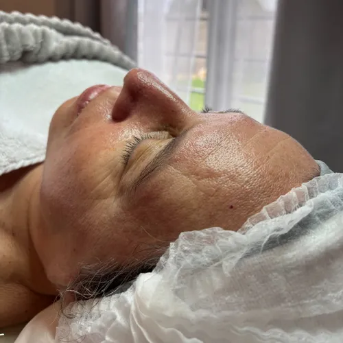 Peeling químico